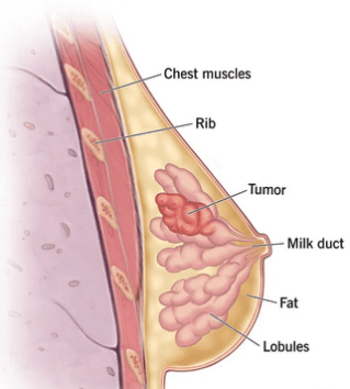 what is breast cancer